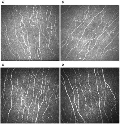 Corneal Confocal Microscopy Demonstrates Corneal Nerve Loss in Patients With Trigeminal Neuralgia